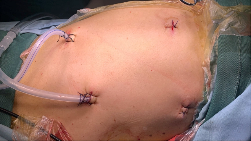 食管癌案例分享:新辅助化疗 微创mckeown手术 - 好大夫在线