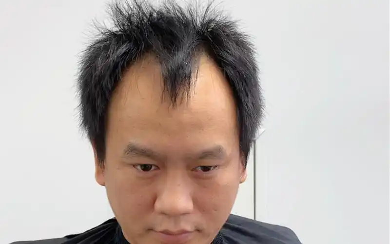 男生m型发际线这样做至少年轻十岁