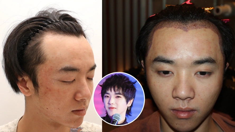 网曝华晨宇秃顶整容,素颜公开不堪入目,满脸痘好似中年油腻大叔