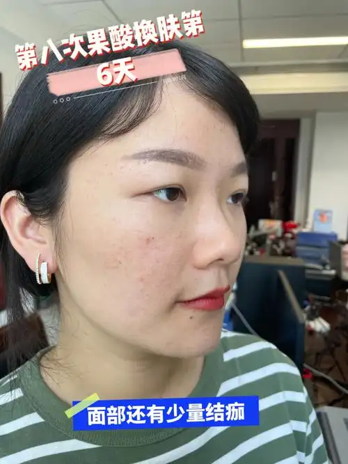 第八次果酸换肤第6天