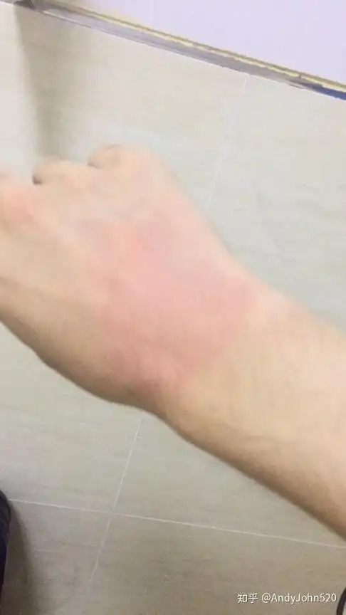 手被开水烫伤了怎么办