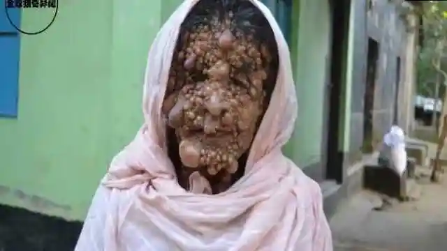 印度妇女全身长满肉瘤十分恐怖密集恐惧症勿点