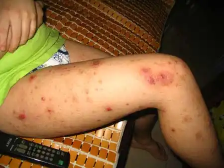 小宇手上,腿上的发病症状.