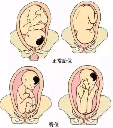 臀位外倒转术,助力臀位孕妈成功顺产