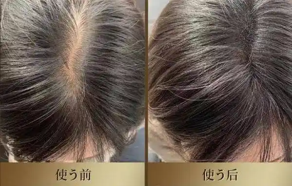 什么洗头膏可以防止脱发防脱黑宝瓶有点东西呀