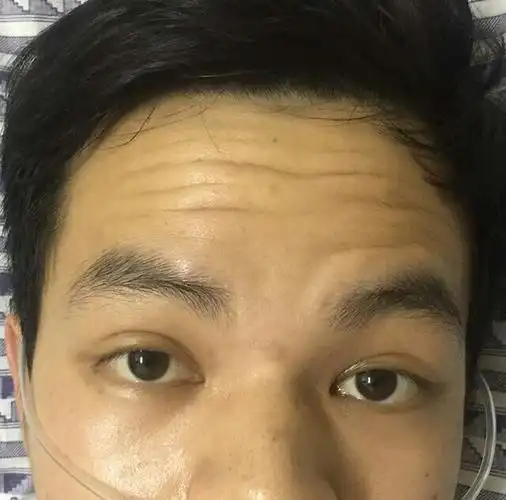 常有重症肌无力病友咨询要不要做胸腺手术? - 好大夫在线