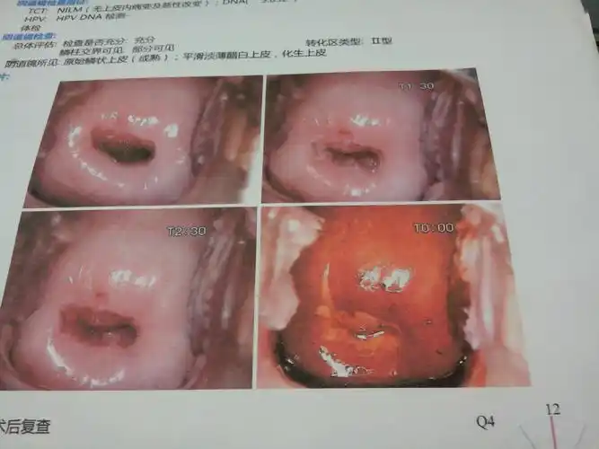 推荐回答 病情分析:   您好,根据您描述的情况,结合发上来的阴道镜