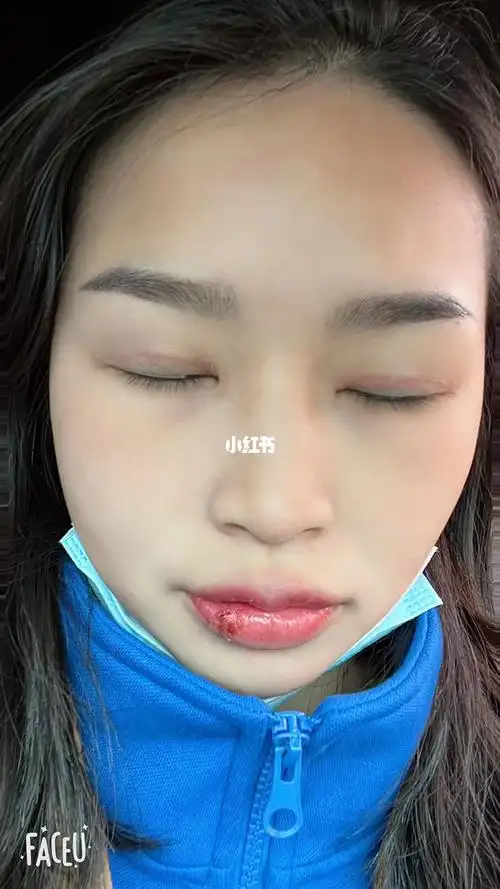 双眼皮修复后一个半月的闭眼情况