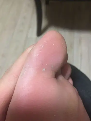 左脚大脚趾脱皮有点痒,最近脚丫子酸臭,是怎么回事,怎么处理