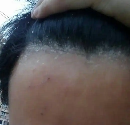 女生的头癣初期图片_有来医生