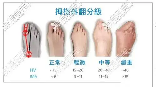 武汉做拇指翻手术好且便宜的医院,微创治疗拇外翻医院 价格