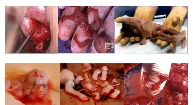 残忍的堕胎过程 大部分的堕胎是在前十二个星期内进行的,胎儿仍然很小