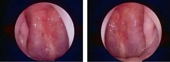 这种癌症治愈率为90%,一定要早发现早治疗!