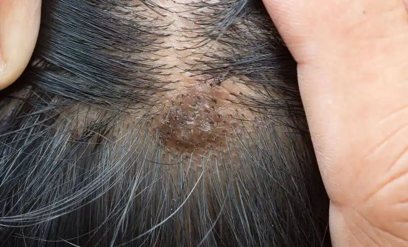 头皮上总是长痘痘,长脓包,怎么回事?