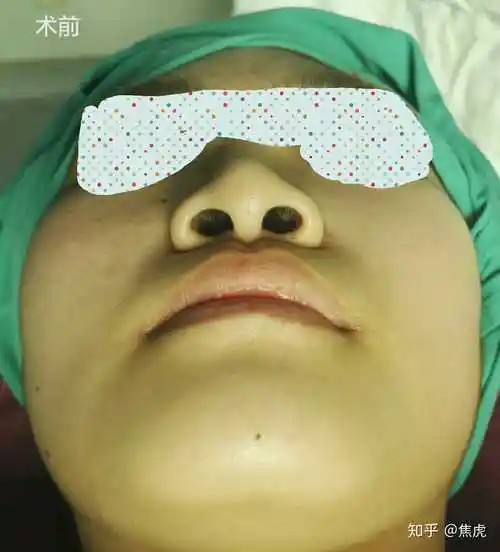 鼻翼缩小手术需要综合考虑鼻翼形态,鼻孔大小以及鼻槛宽度等因素,根据