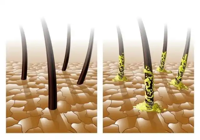 头皮发根毛囊上油脂非常多怎么办这个是脂溢性堵塞吗
