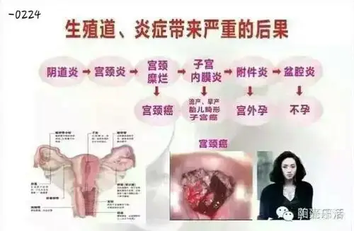 白带异常的六种症状,预示你已患上妇科病.