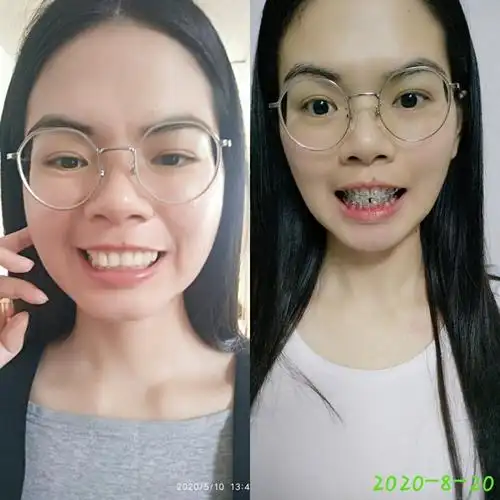 牙套3个月变化还是有的