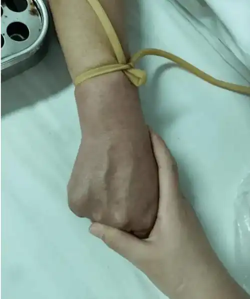 静脉输液无痛穿刺要点_血管_患者_护理