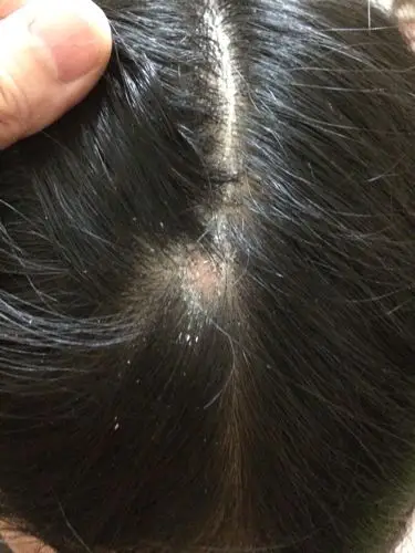 头皮微痛,白色痂状物,轻扯掉下头皮带头发,大约2平方厘米.是什么病啊?
