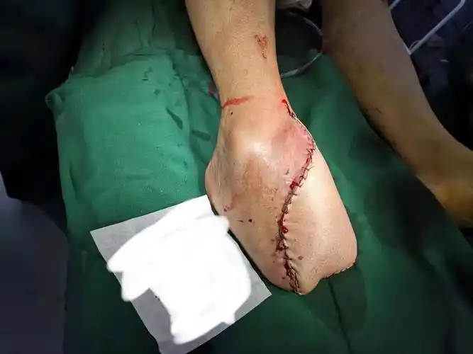 股前外侧穿支皮瓣修复术治疗右足碾压伤