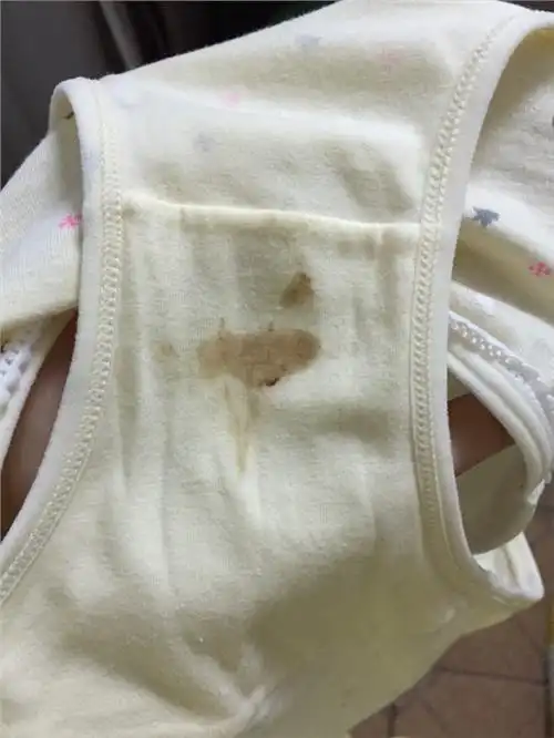 白带褐色应该怎么办