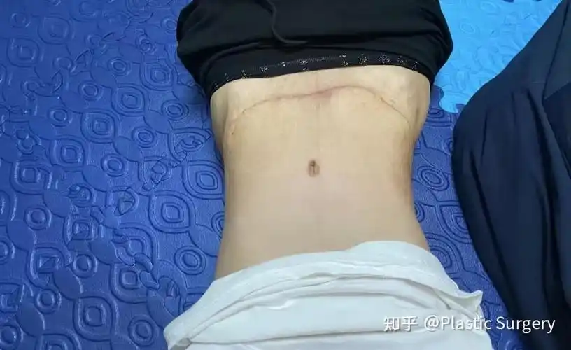 二胎妈妈分享腹壁成形 腰腹吸脂 妈妈臀抽脂心路历程