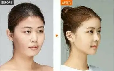 山根低和鼻梁低的区别哪个严重?合肥鼻哥缪建华如何矫正?