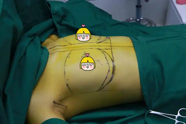 2,切口:腋窝切口; 3,假体材料:曼托假体; 4,假体大小:左侧245cc,右侧