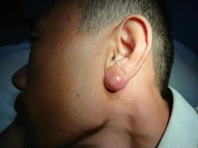 耳垂皮脂腺囊肿感染