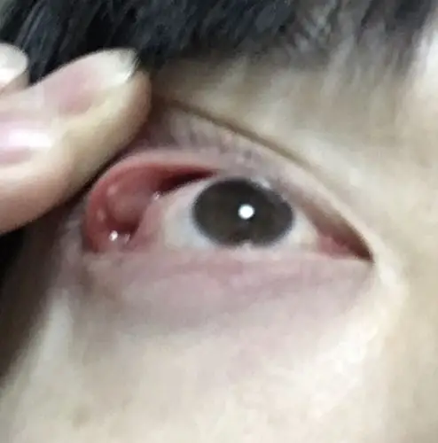 上眼皮里面长了个疙瘩,帮看看是什么鬼.