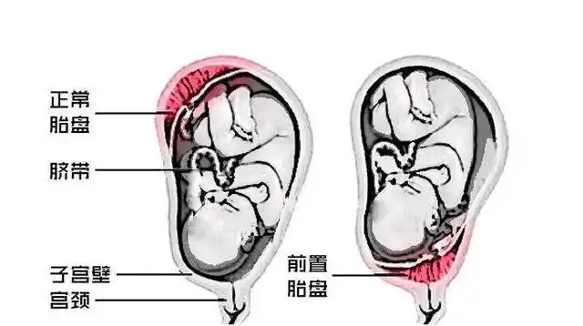 只要在这个位置都正常,变化了就不行|胎盘|后壁|子宫_新浪新闻