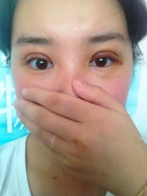 全切双眼皮做的是扇形的8mm术后有十一天了