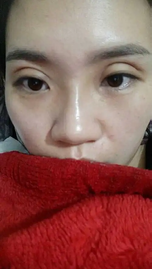 全切双眼皮15天,太宽太深不对称,该怎么办?还会变窄吗?