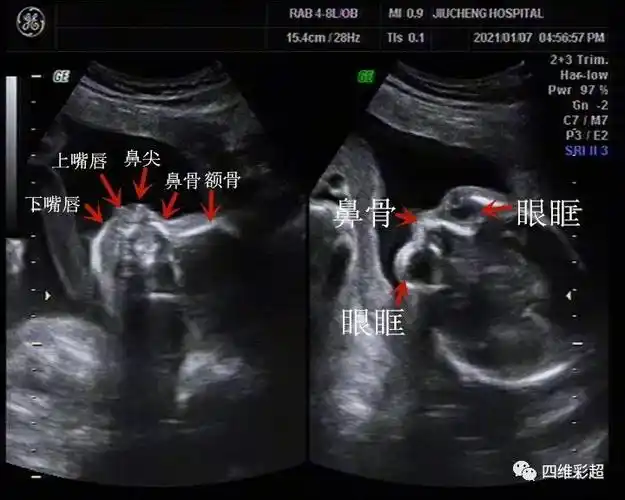 经典病例之鼻塌中面部发育不良binder综合征