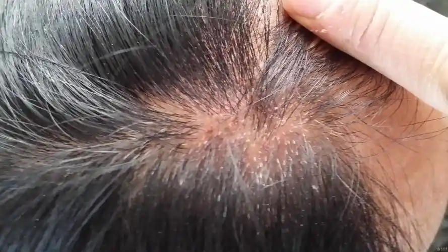 染发引起的过敏 - 全科医疗专业讨论版 - 爱爱医医学论坛