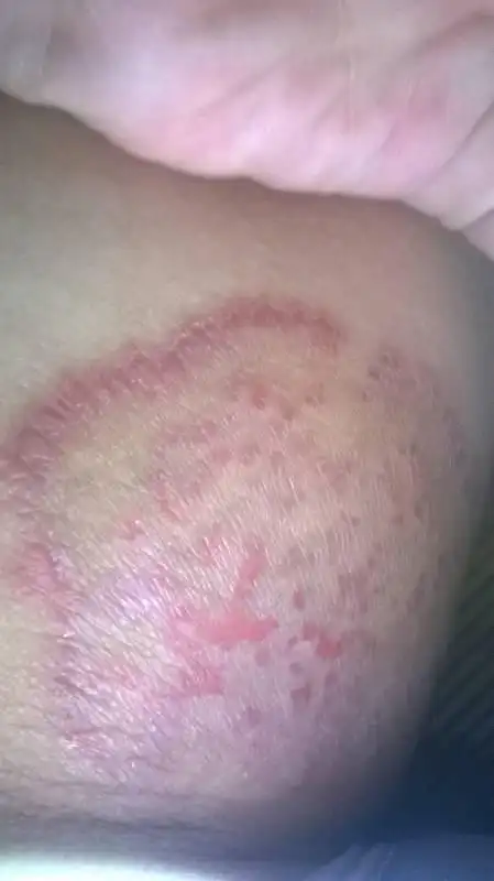 阴囊旁边大腿内侧有红斑,经常痒得厉害去挠,持续四个月左右了,开始