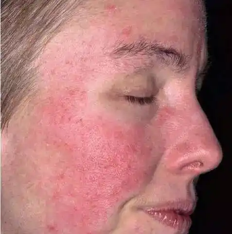 脸干燥脱皮紧绷反复发作很可能是你踩了这5个敏感肌护理雷区