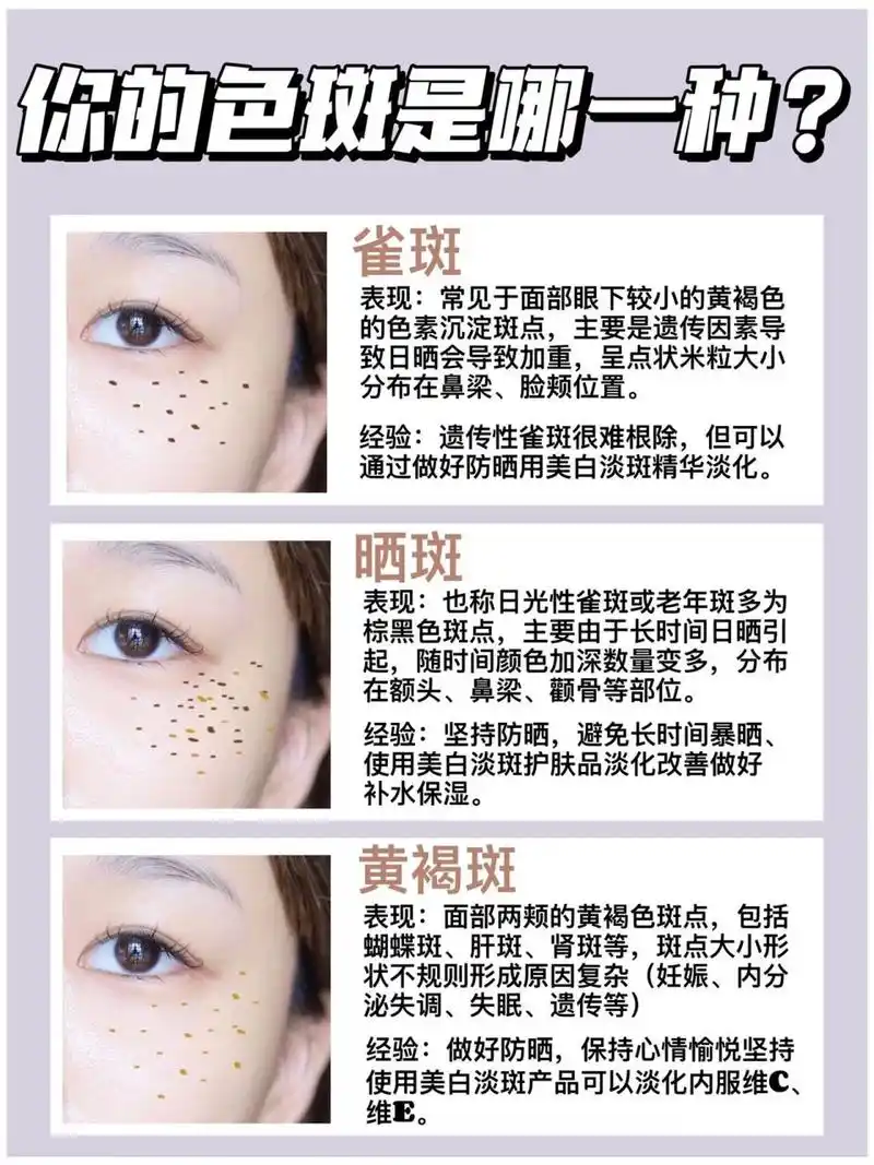 斑点类型科普|没分清就别再瞎淡斑了 7515雀斑表现:常见于面部眼