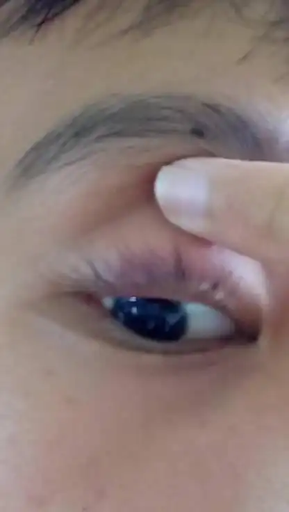 昨天刚长的麦粒肿,昨天本来很大的,吃了点药,滴了眼药水,热敷了4次