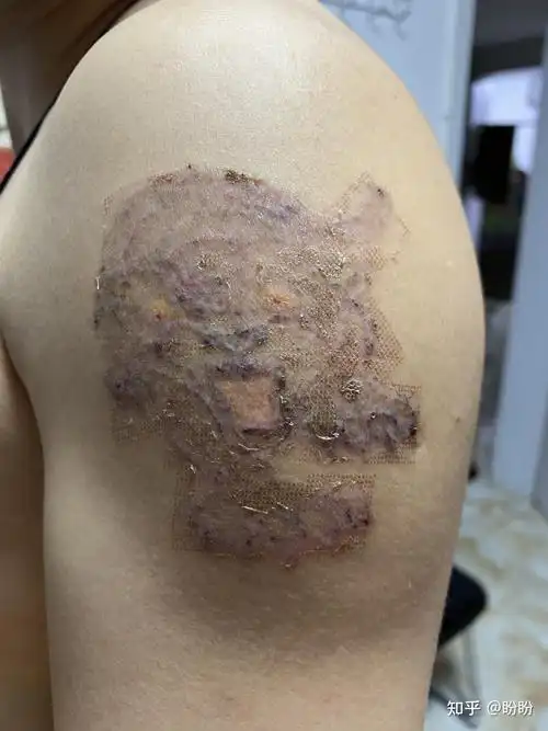 8年的老纹身有轻微增生,因为工作原因客户要洗掉,还没完全恢复好,刚第