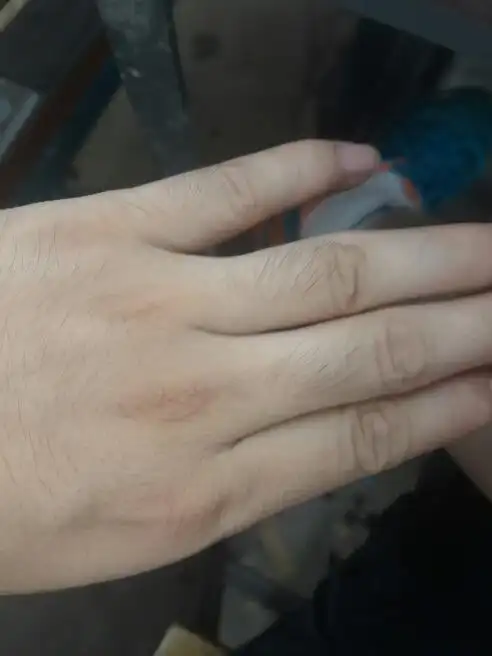 手毛长怎么办 长的是那种幼毛 但是普通的都1厘米 多,长的都2厘米