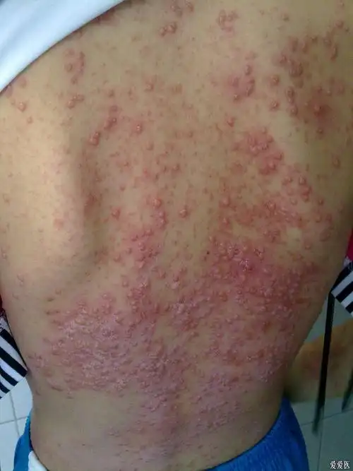 患儿1月前出现双下肢,双侧臀部散在皮疹,当时诊断"过敏性紫癜",予西米