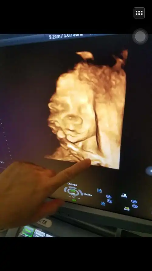 孕24周做的四维彩超,怎么宝宝拍出来的照片,这个样子啊,鼻子大,还有