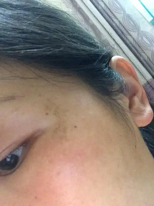 那位知道这是什么斑