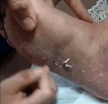 女子好吃懒做几年不洗脚,声称脚不臭不粘,技师修脚时被整懵了_网易