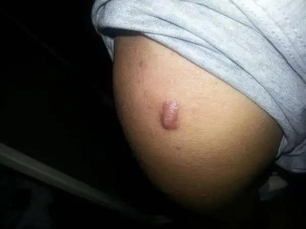 请问医生我身体上长的这个疙瘩要不要紧 不痛不痒的 先谢谢了!