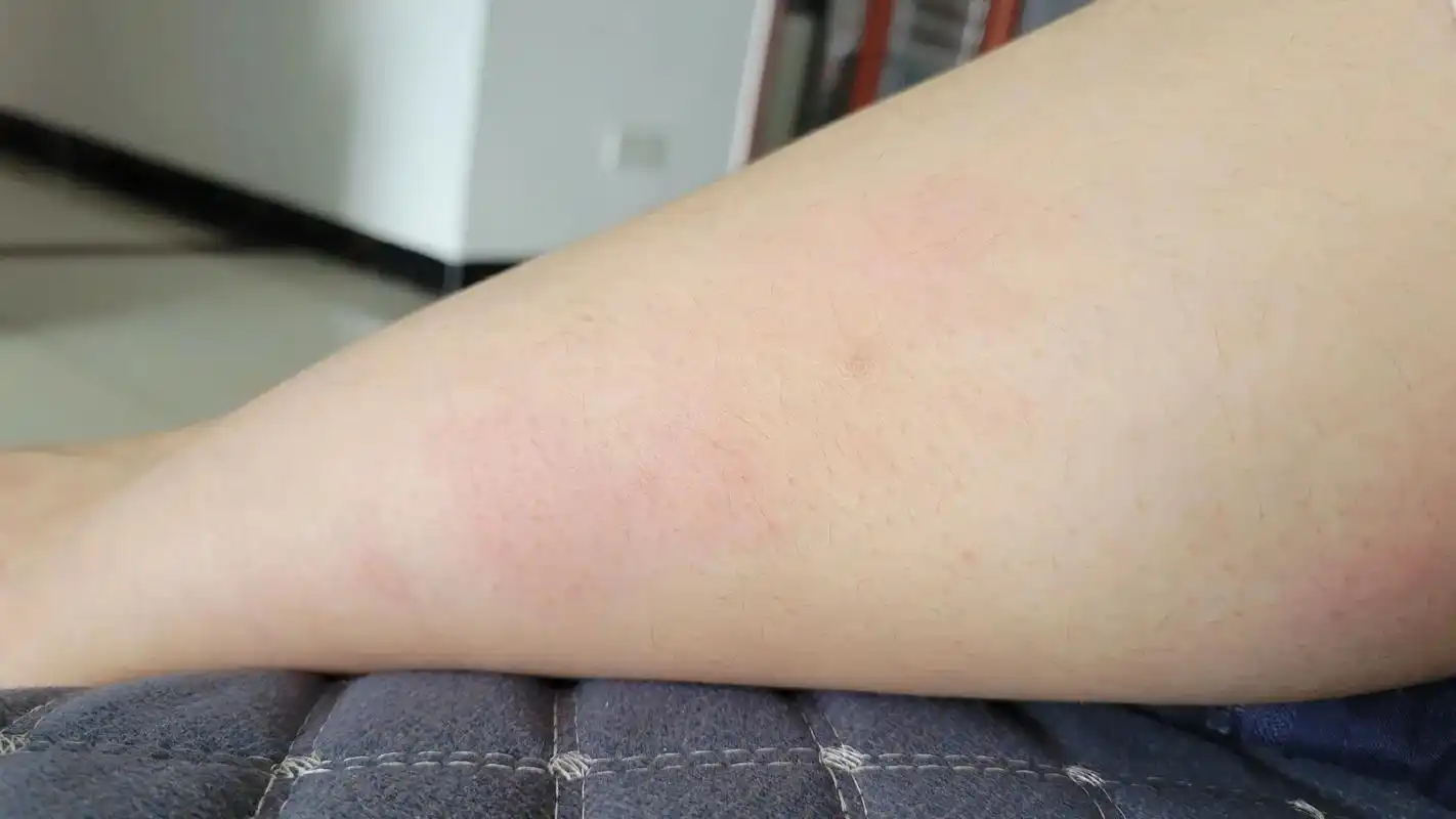 腿上起了包不知道是蚊子咬的还是螨虫过敏,但是像蚊子包一样痒.