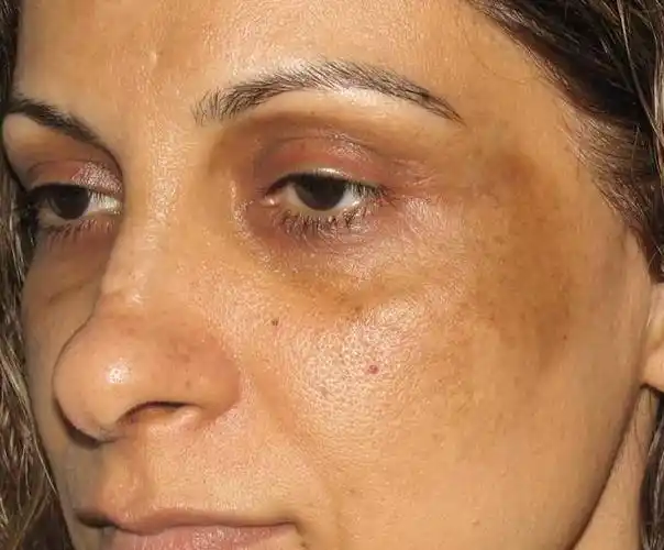 色斑图片女士脸部中度的图片女士脸部长色斑图片女士面部严重色斑图片