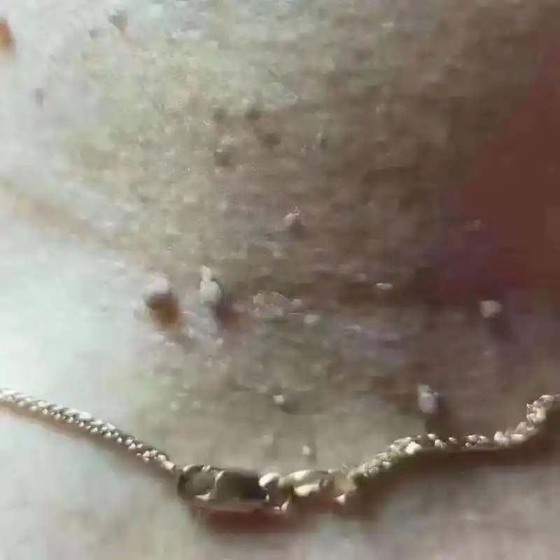 你身上的小肉揪儿疣传染吗